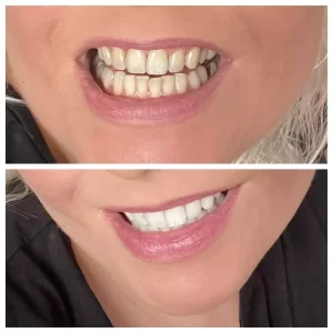 5D Whitening Dantų balinimo juostelės – 14 dienų